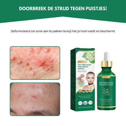 AcneEase® | Natuurlijke Ondersteuning voor een Heldere Huid