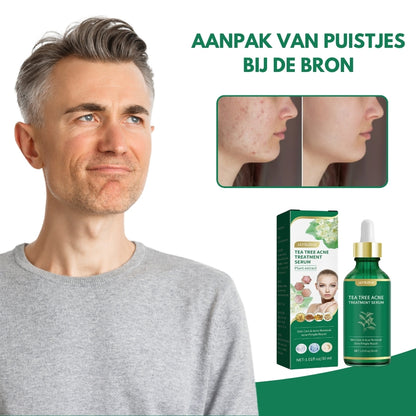 AcneEase® | Natuurlijke Ondersteuning voor een Heldere Huid